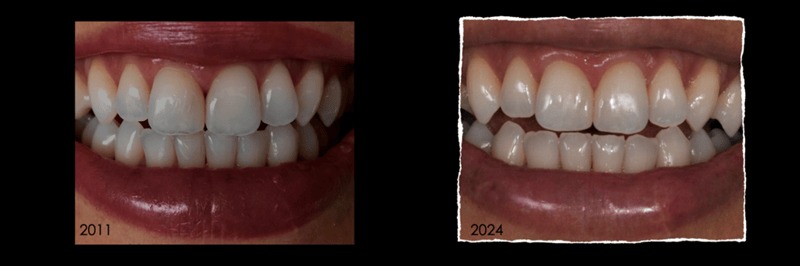 hình 3: tình trạng lâm sàng sau 13 năm