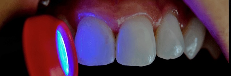 hình 4 & 5: quan sát với chế độ hỗ trợ chẩn đoán bằng ánh sáng đen