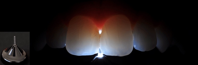 hình 8 & 9: quan sát với thấu kính mặt bên (interproximal lens)