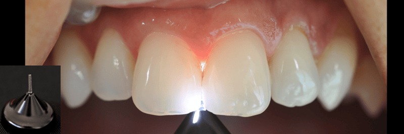 hình 8 & 9: quan sát với thấu kính mặt bên (interproximal lens)
