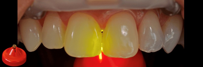 hình 6 & 7: quan sát với thấu kính translume
