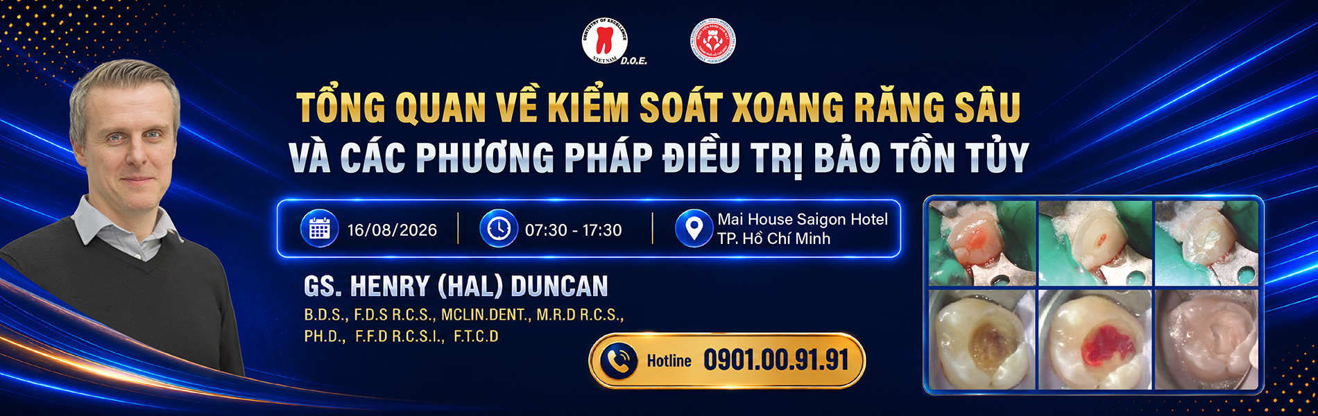 kiem soat sau rang dieu tri tuy song henry duncan 3