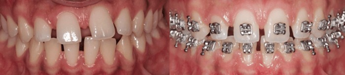 hình 1: hình ảnh tổng hợp về tình trạng ban đầu và quá trình chỉnh nha.