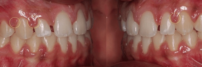 hình 3: vùng nướu cần điều chỉnh được làm nổi bật