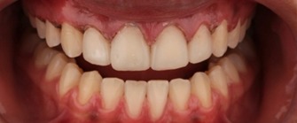 hình 6b tổng hợp các góc chụp hậu phẫu tức thì