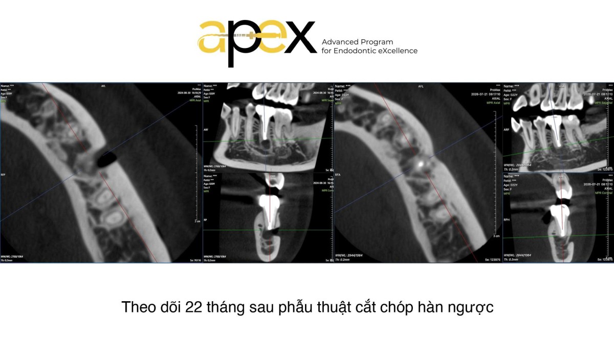 nội nha chuyên sâu 4 noi nha chuye sau anh lam sang 2